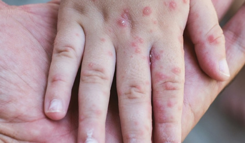 Өнөөдрийн байдлаар Улаанбурхан өвчний 13.677 тохиолдол бүртгэгджээ